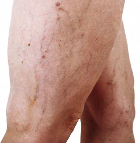 Angiología y cirujano vascular