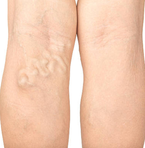 Clínica de angiología en CDMX