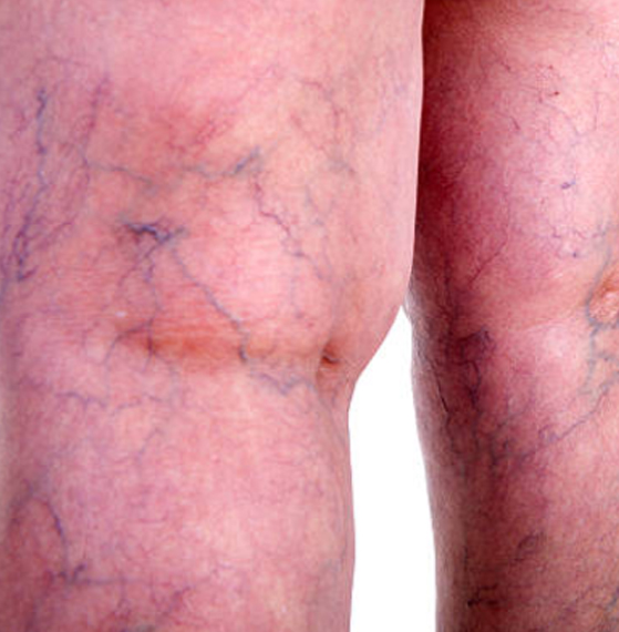 Clínica de heridas y estomas