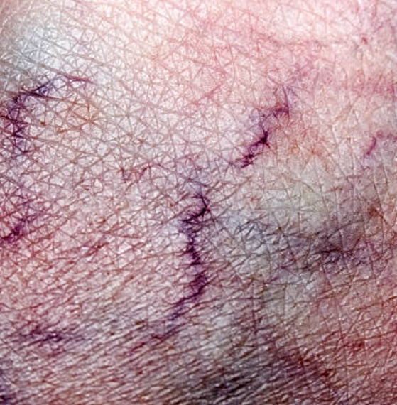 Clínica de heridas y pie diabético