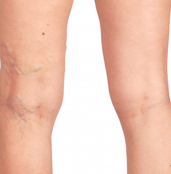 Consulta de angiología