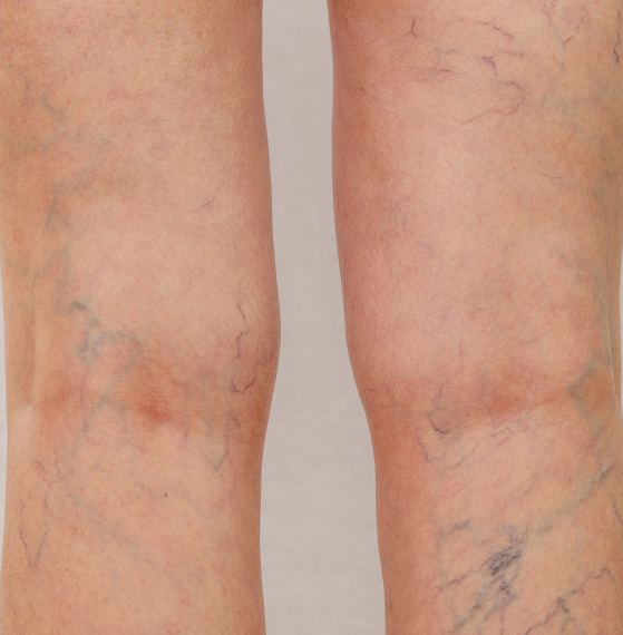 Insuficiencia venosa crónica