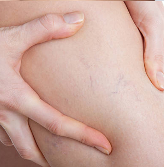 Insuficiencia venosa diagnóstico