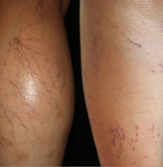 Insuficiencia venosa tratamiento