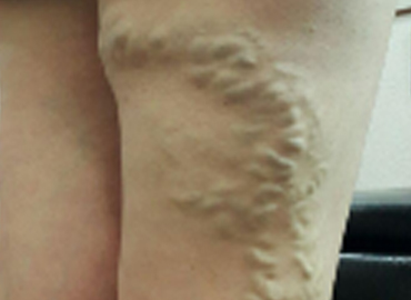 Cirugía por insuficiencia venosa crónica