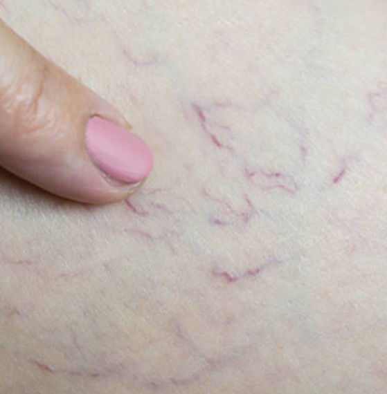 Médico angiólogo CDMX