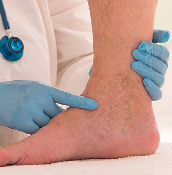 Pie diabético tratamiento