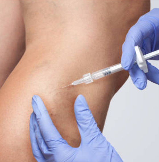 Insuficiencia venosa crónica tratamiento