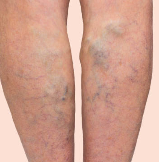 Úlcera en pie diabético tratamiento