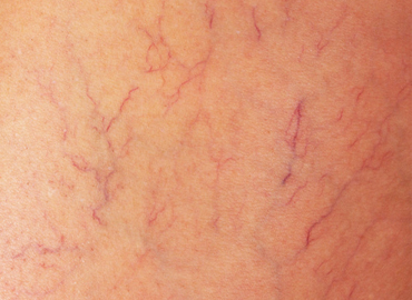 Ultrasonido vascular periférico