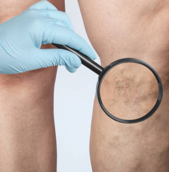 Venas varicosas escleroterapia